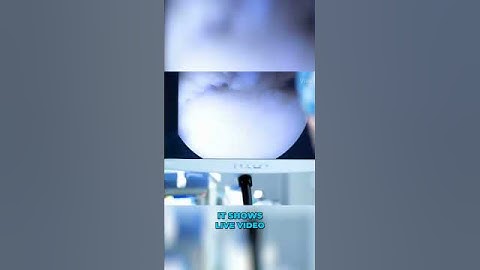 Ankle Arthroscopy (3D animation)