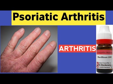 Video: Artritis Dan Pemakanan Psoriatik: 8 Jawapan Pakar