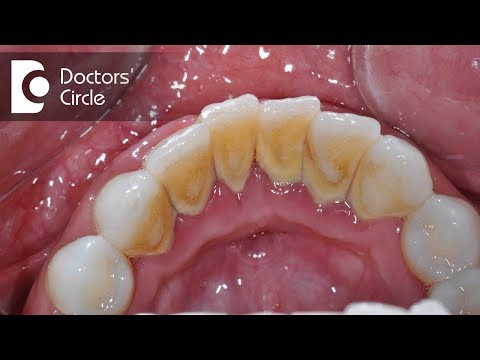 Video: Čo je v zubnom lekárstve tvorba vodného kameňa?