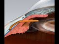 Glaucoma microtube procedure