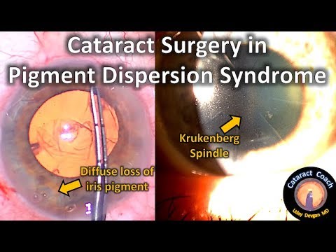 Cataract Surgery in Pigment Dispersion Syndrome