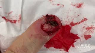 Fungus Infected Fingernail Needs to Be Removed | CONTOUR DERMATOLOGY