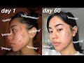 I CLEARED MY ACNE *60 days using Differin Gel Adapalene 0.1% + pictures!*