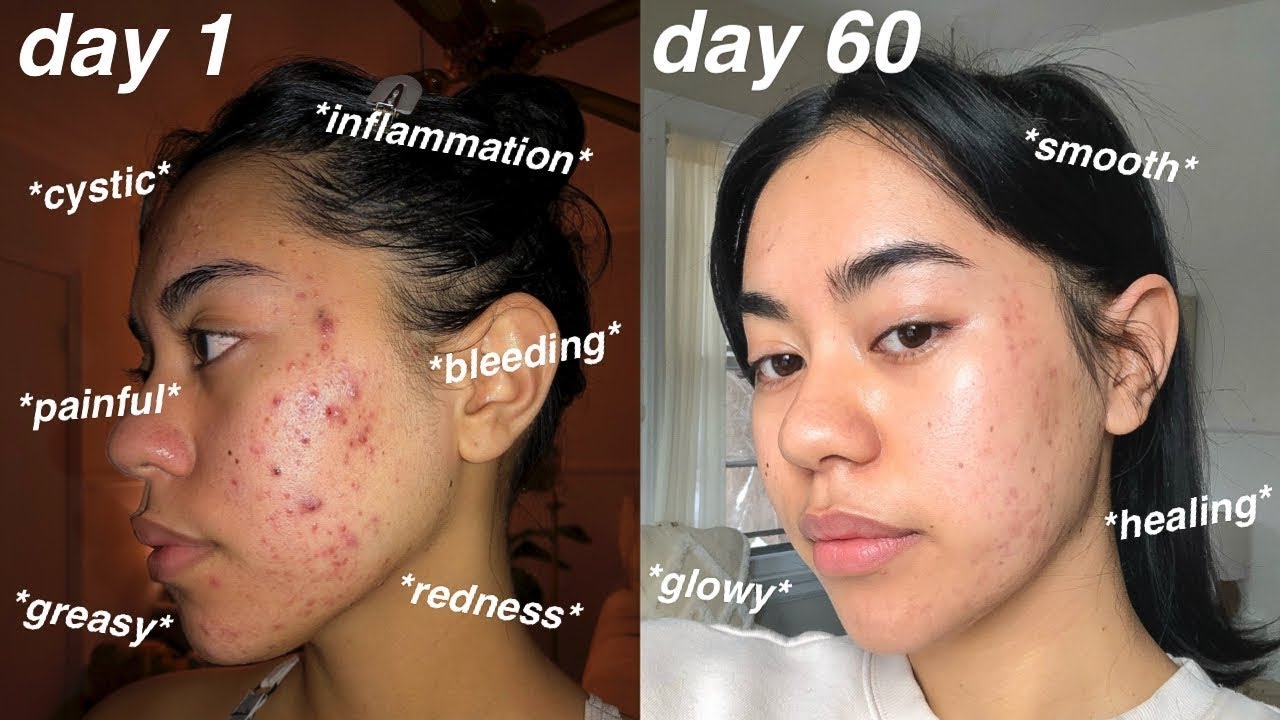 I Cleared My Acne 60 Days Using Differin Gel Adapalene 01 Pictures