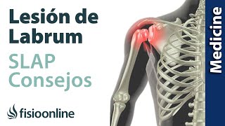 Consejos para solucionar la lesión labrum de hombro (SLAP)