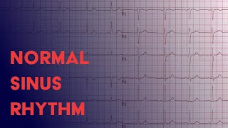 Normal Sinus Rhythm -  EKG (ECG) Interpretation