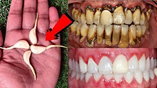 सिर्फ 2 मिनटों में पीले गंदे दांतों को मोती की तरह चमका देगा ये नुस्खा | White Teeth home remedy