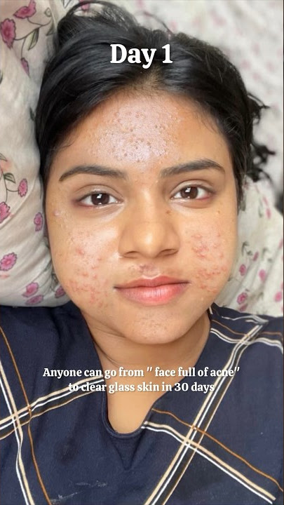 Anyone can go from 'Face full of acne' to 'clear glass skin' in 30 days #shorts #skincare #acne