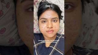 Anyone can go from "Face full of acne" to "clear glass skin" in 30 days #shorts #skincare #acne screenshot 2