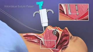 Encore Surgical Procedure for OSA Animation screenshot 2