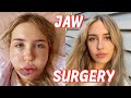 I had Double Jaw Surgery | VLOG & recovery