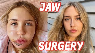 I had Double Jaw Surgery | VLOG & recovery