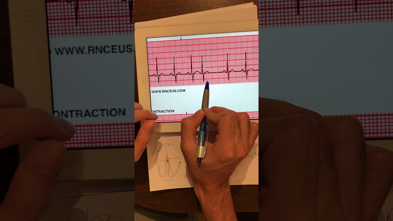 5 Extrasystole examples YouTube 5 Extrasystole examples YouTube