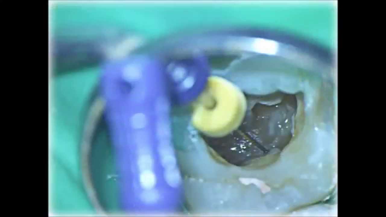 Лечение зубов под микроскопом. Извлечение инструмента. Поиск скрытых корневых каналов.