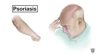 Mayo Clinic Minute - Psoriasis of the scalp