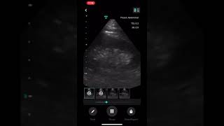 How to Use the Vave Health Ultrasound App screenshot 5