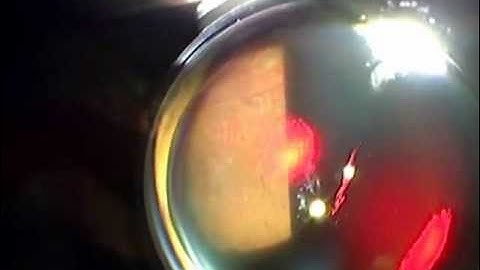 PASCAL photocoagulator in action