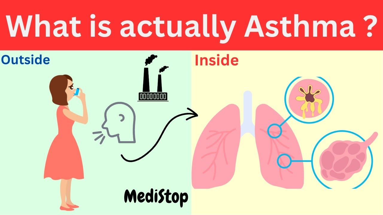 An Overview of Asthma Disease Causes and Symptoms of Asthma Disease