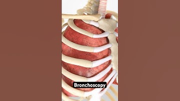 What is Bronchoscopy? (3D Animation)