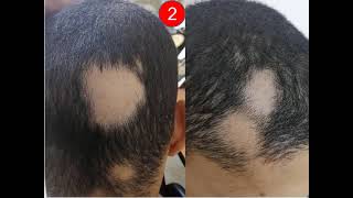 1Interactive_Dermatology_Clinic Images 1 Herpes simplex 2 Alopecia areata 3 Aquired ichthyosis