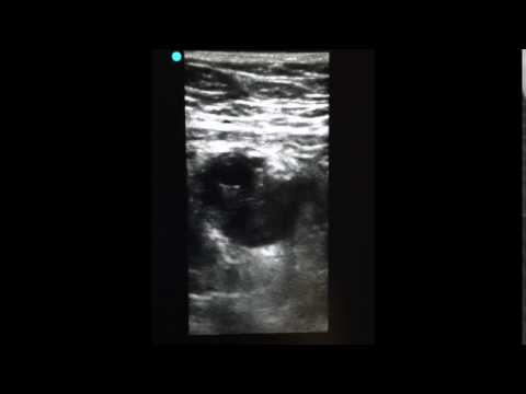 Video: Er cefalisk venetrombose en DVT?