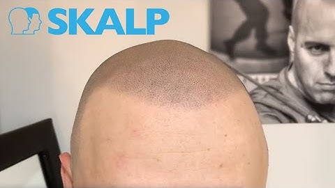 Scalp Micropigmentation Soft Hairline by Skalp®