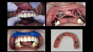 Graphene _ All on 6 Prosthesis case presentation by Asian Dental Academy