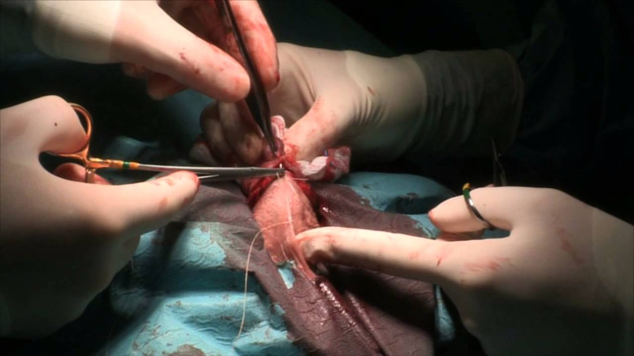 Besnijdenis - Totale Circumcisie - Youtube