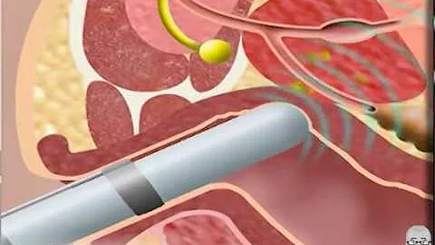 Come si fa la biopsia all'utero?