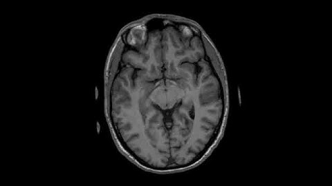 MRI of the brain while dreaming