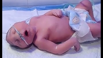 Bayi Mikrosefalus | Perjalanan Medis yang Memilukan 💔 | Perjuangan NICU & Harapan Keluarga