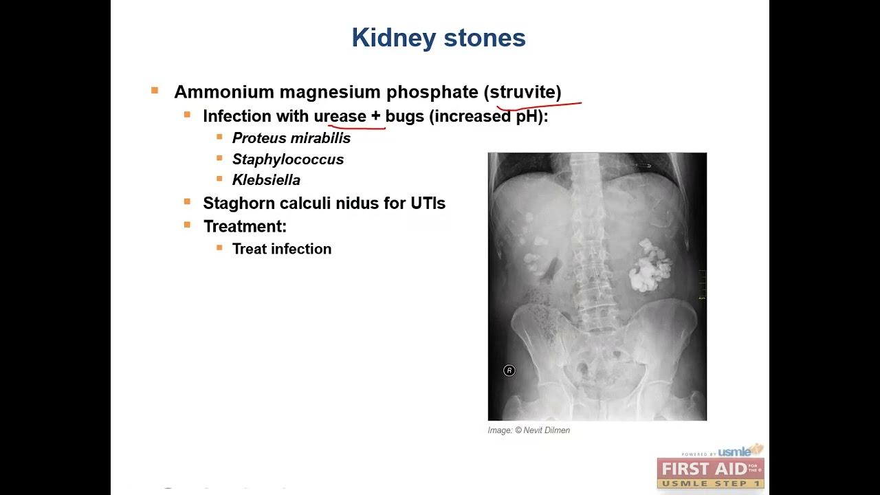 Kidney stones or Nephrolithiasis, Renal pathology video part4 from