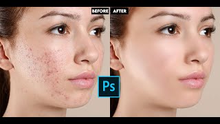 High End Skin Retouching in photoshop. How to remove face pimple in photoshop.