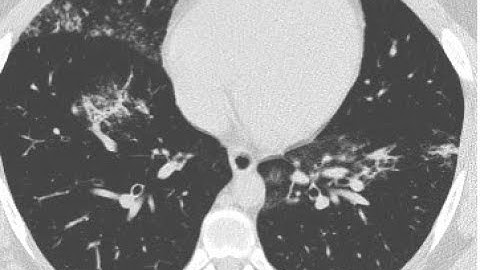 COVID Detection using Lung CT Images || MATLAB