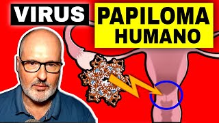 Síntomas del VPH (VIRUS del PAPILOMA HUMANO): Cáncer, Vacuna, Diagnóstico y Tratamiento