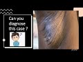 White Axillary Discharge | Can you diagnose this case ? | Case 6