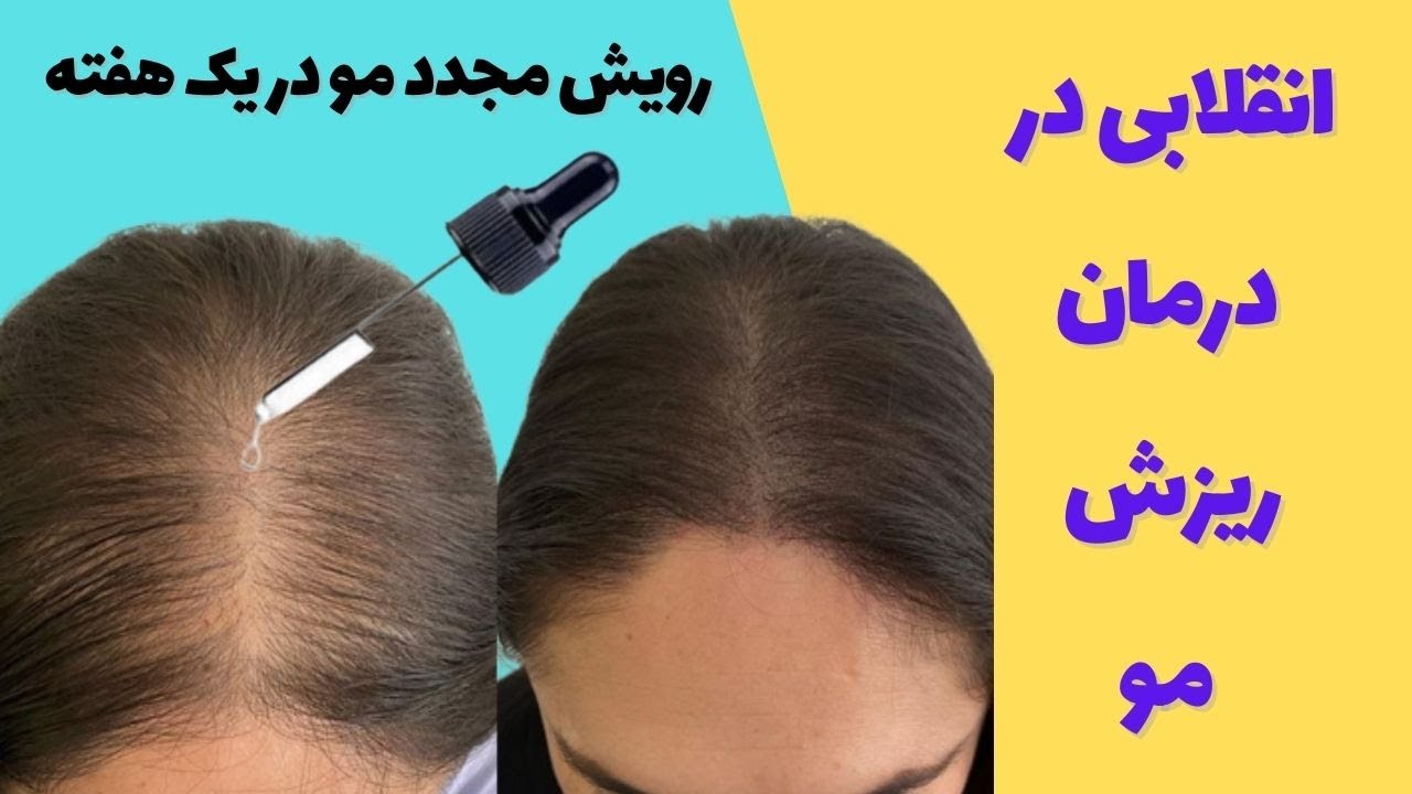 درمان ریزش مو و رویش مجدد مو/ فرمولی بی نظیر برای درمان سریع ریزش مو و افزایش رشد طول مو در یک هفته