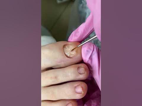 Протезирование ногтей на ногах / Какой гель для протезирования выбрать ...