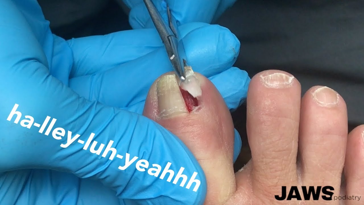 REMOVING A LARGE INGROWN TOENAIL YouTube