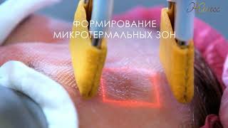 Лазерное омоложение, технологии CO2 и RF