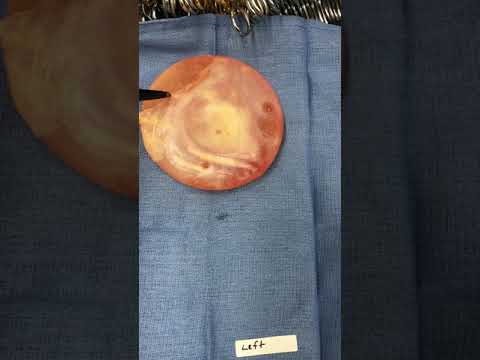 Explant and En Bloc Capsulectomy | Gary Rosenbaum, M.D.