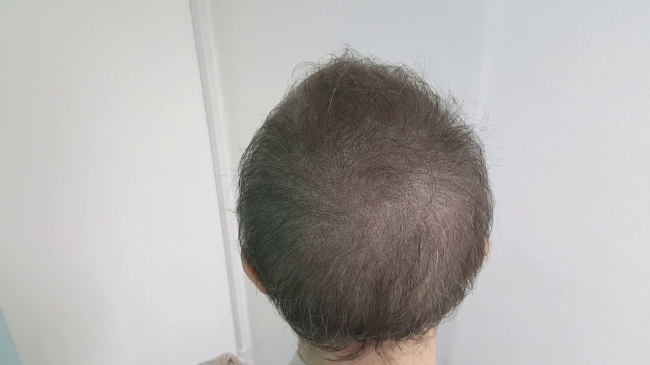 Female Post Chemo SMP Thin Hair Scalp density Micropigmentation by El Truchan @ Perfect Definition