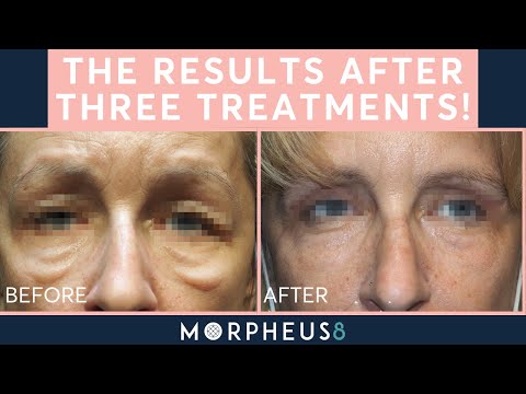 How Morpheus8 Rescued My Under-Eyes from Bad Fillers!