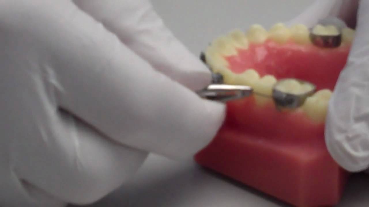 Emergency Care for Loose or Poking Wires Related to Braces YouTube