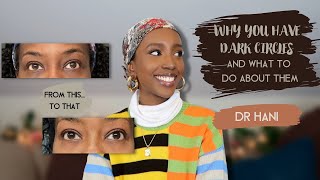 How To Get Rid Of Your Dark Circles! | Dr Hani