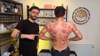 "asmr"vip relaxing massage&cupping😍