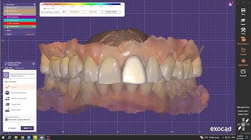 Exocad Veneer Design For Lithium Disilicate on Tooth 21 (Central Incisor)