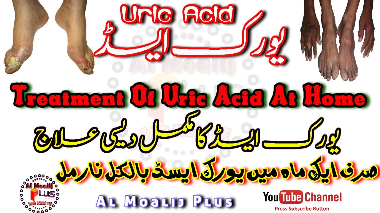 Treatment Of Uric Acid At Home | How To Cure Uric Acid Permanently