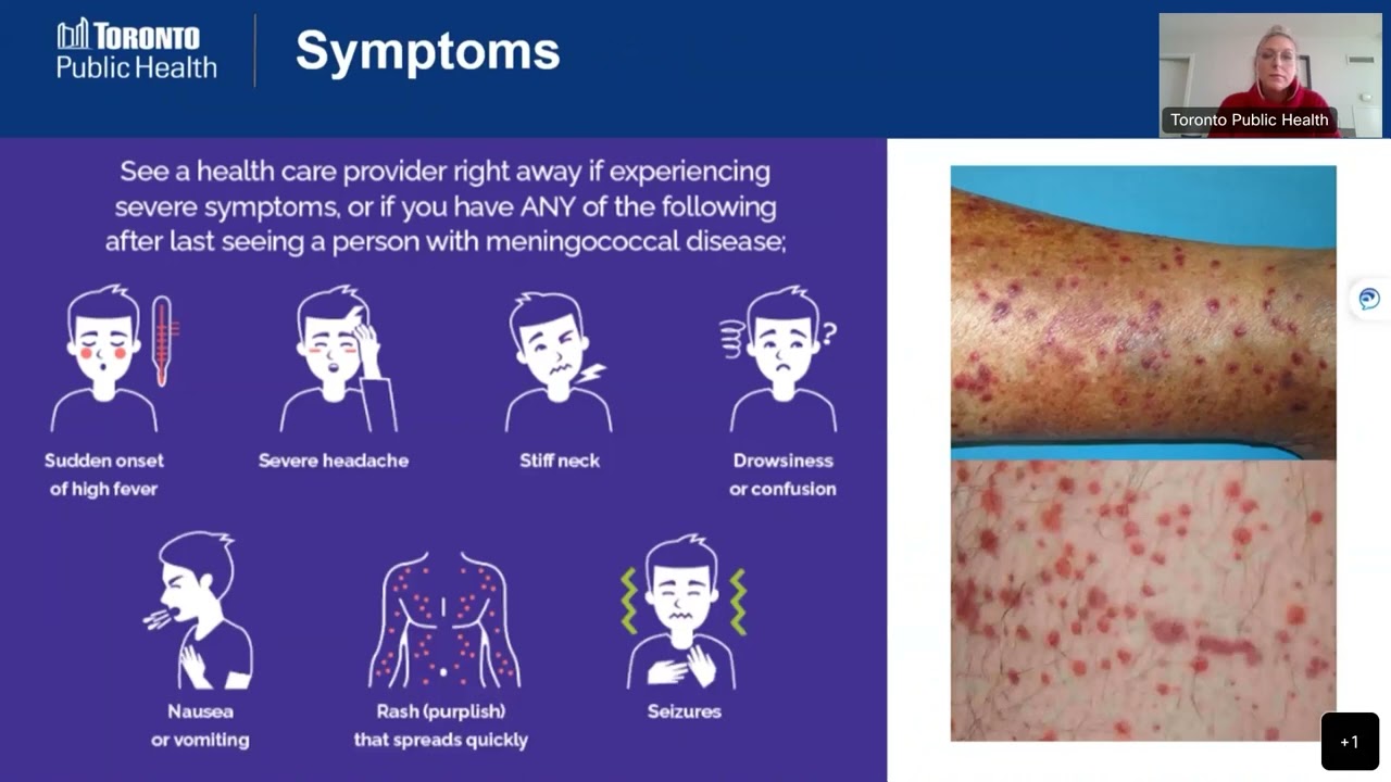 Nemaggitis Rash Neisseria Meningitidis Symptoms Meningitis: Practice Essentials,