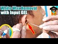 ►Large Earwax Plugs Removal ASMR BD II Input GEL for Fungal Protection II Money Paid Cordially